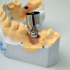 Individuální Abutment